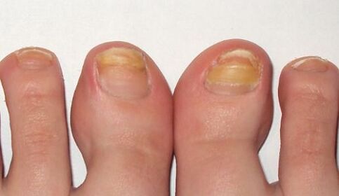 nail fungus stage