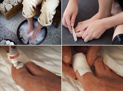 Steam the feet and apply urea cream on the fungus affected nails