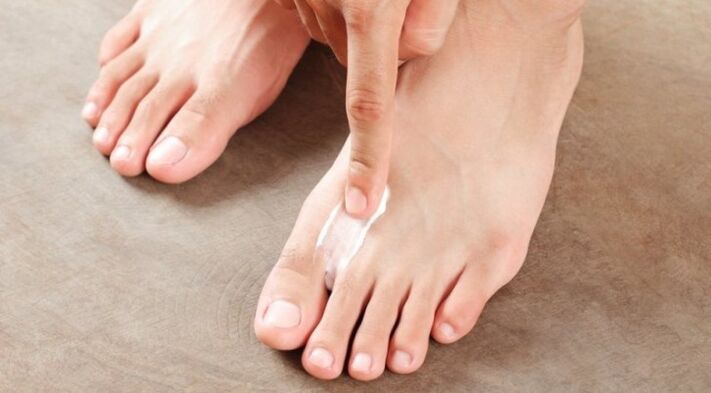 how and how to treat fungus between the toes