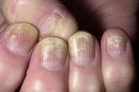changes in nails with fungal infections