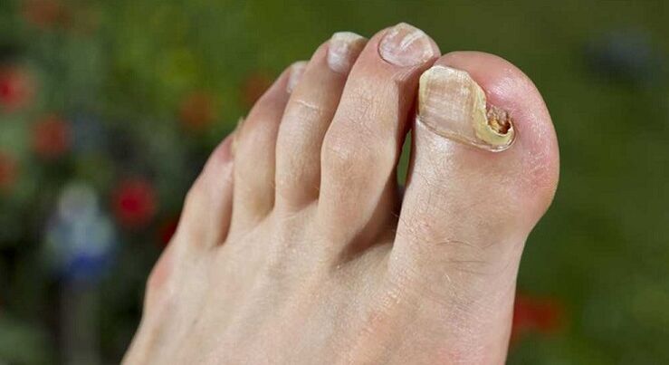 damage to the nails with fungus on the feet
