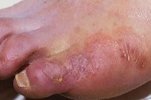 manifestations of fungal infections on the skin of the feet