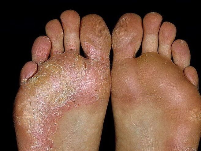 fungal symptoms on the feet