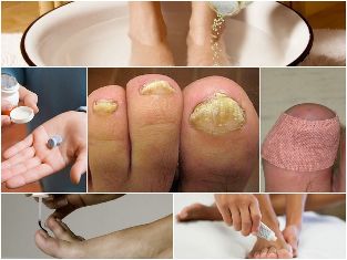 the fungus on feet treatment