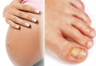 the fungus on the feet pregnancy