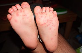 The fungus in the feet