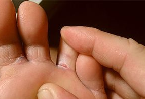 The fungus on the feet of an adult person