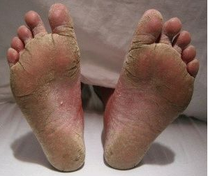 the fungus on the feet as it seems