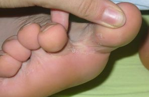 The fungus between the toes of the feet