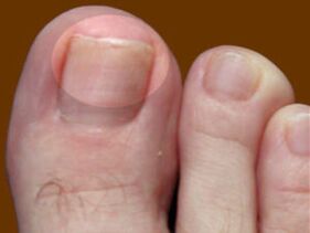 Toenail fungus - an indication for the use of fungal drops