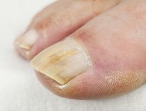 When suppuration near the nail, you should not use antifungal drops