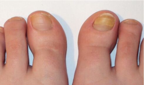fungal infections of nails