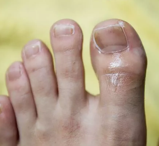 Fungus of the toenail of the big toe of the