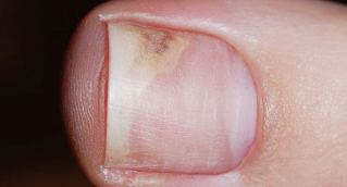 The symptoms of the initial phase onychomycosis