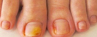 the nail fungus in the feet symptoms