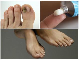 the nail fungus on feet treatment