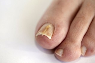 the nail fungus on the feet
