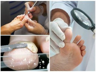 the fungus, in the skin of the feet, the diagnosis of