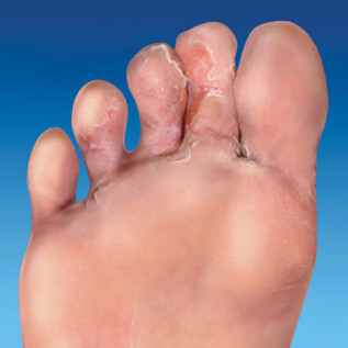 the fungus, in the skin of the feet