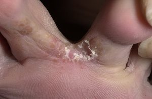 the form of the fungus in the feet