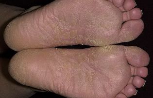 the fungus in the feet