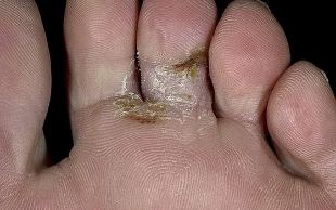the types of fungi on the feet